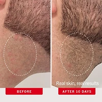 'Ingrown Hair Pads with AHA + BHA for Body + Face'