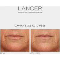 Caviar Lime Acid Peel
with Glycolic Acid 10% + Phytic Acid 10% + Retinol