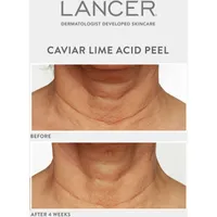 Caviar Lime Acid Peel
with Glycolic Acid 10% + Phytic Acid 10% + Retinol