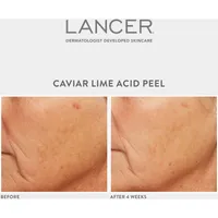 Caviar Lime Acid Peel
with Glycolic Acid 10% + Phytic Acid 10% + Retinol