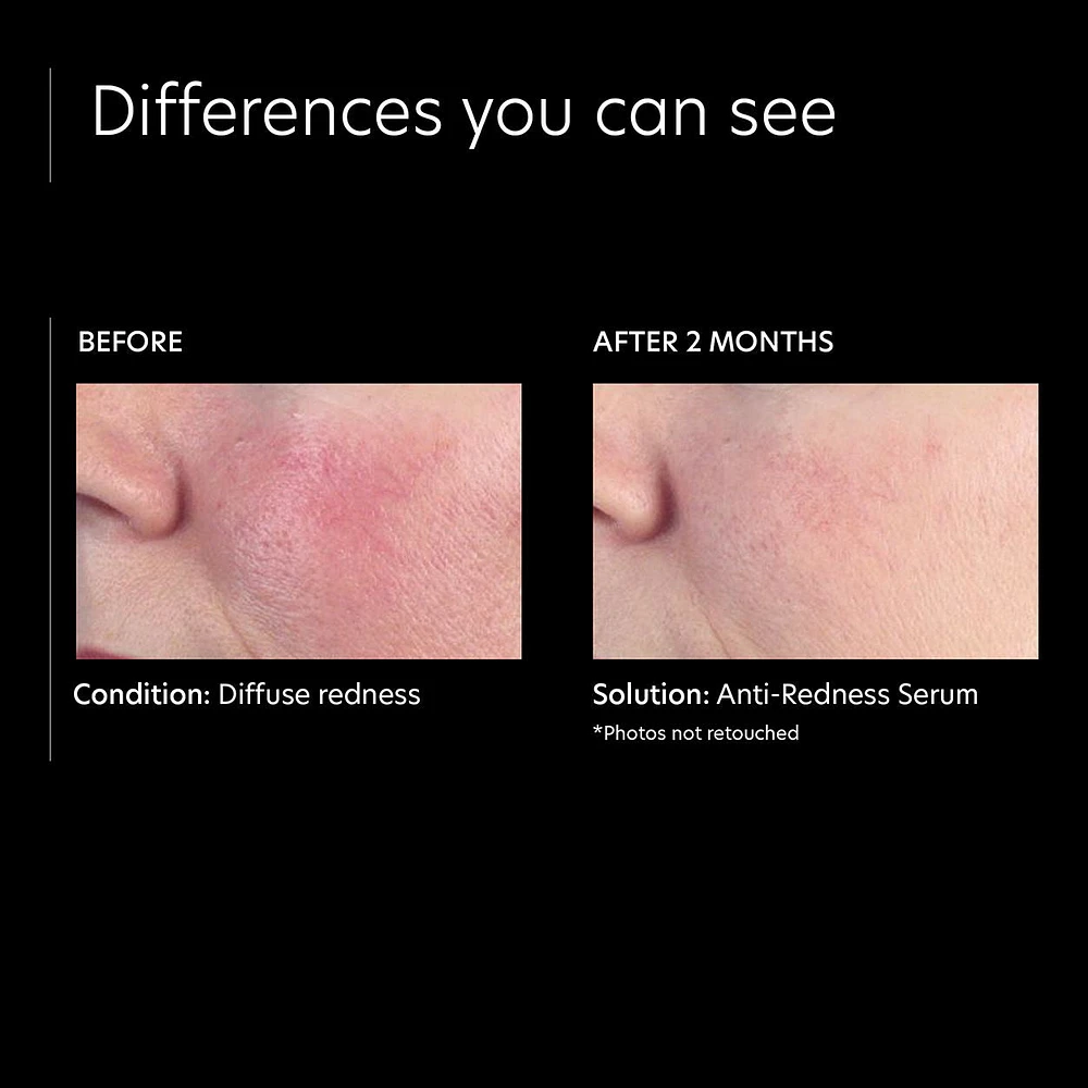 Anti-Redness Serum