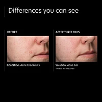 Acne Gel With OmniSome