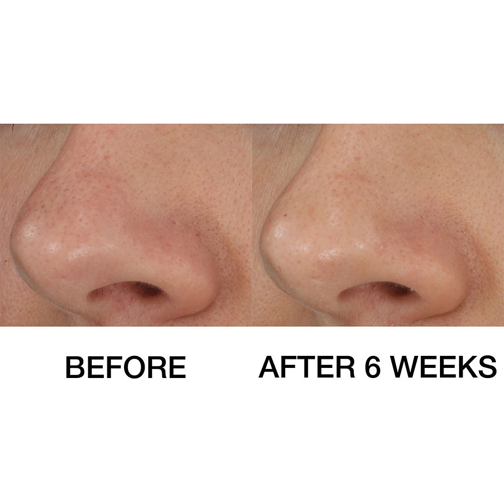 Blackhead Solutions Self-Heating Blackhead Extractor