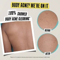 Expertly Clear Acne-Treating & Preventing Lotion