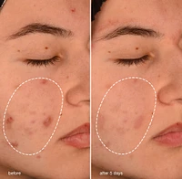 Acne Biotic Moisturizer