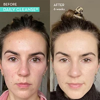 Daily Cleanse Clear Skin and Acne Supplement