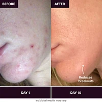 Bye Acne: 3-Minute Pimple Spot Treatment