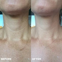 Wrinkles Schminkles Neck Patch