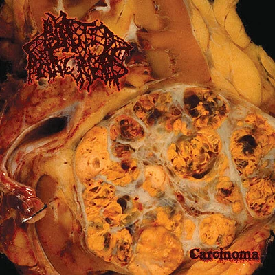 Blasted Pancreas - Carcinoma