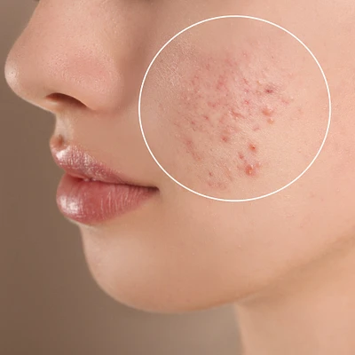 Acne Treatment | 3 Services