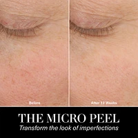 The Micro Peel