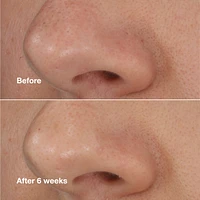 Blackhead Solutions Self-Heating Blackhead Extractor