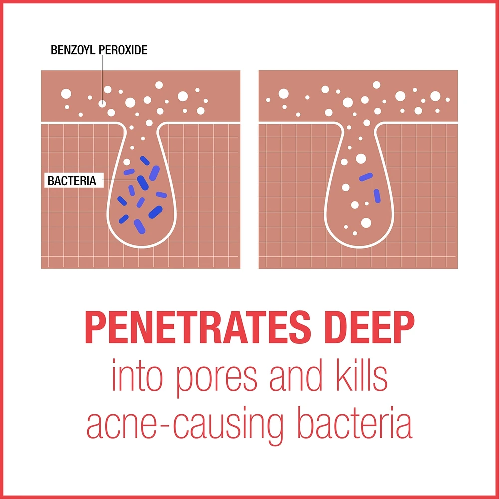 Stubborn Acne AM Facial Treatment