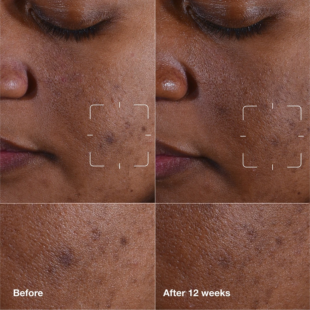 Even Better Clinical™ Dark Spot Clearing Serum with Vitamin C