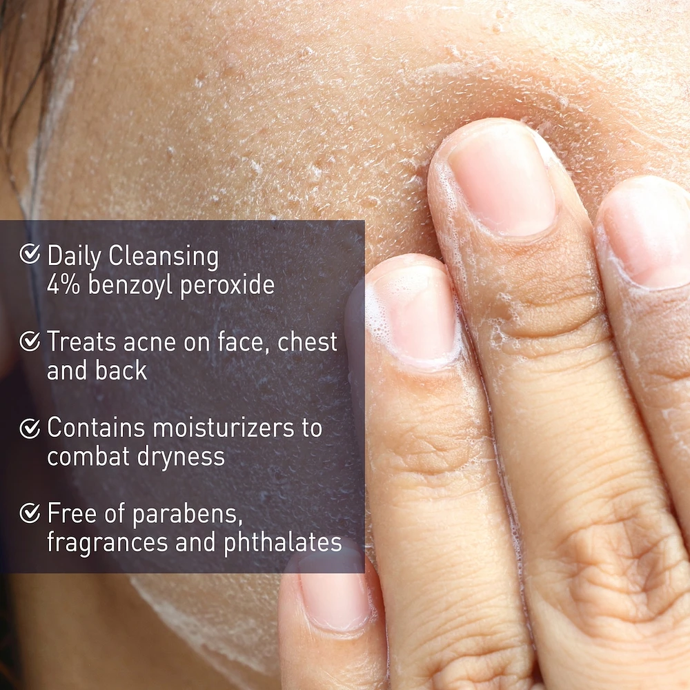 Acne Wash, 4% Benzoyl Peroxide Cream