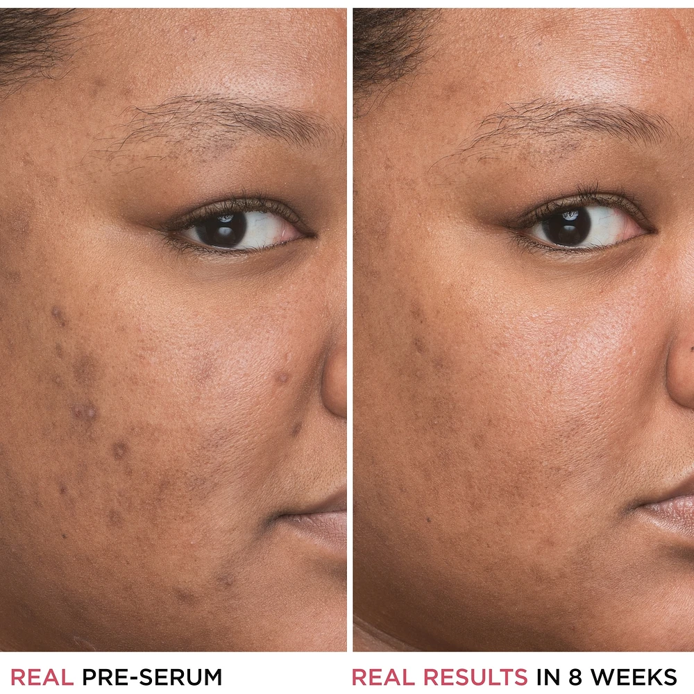 4% Niacinamide, Ethyl Vitamin C Bye Bye Concentrated Derma Serum