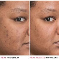 4% Niacinamide, Ethyl Vitamin C Bye Bye Concentrated Derma Serum
