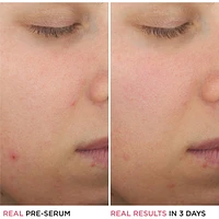 Bye Bye Breakout 2% Salicylic Acid Serum Acne Treatment