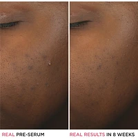 Bye Bye Breakout 2% Salicylic Acid Serum Acne Treatment