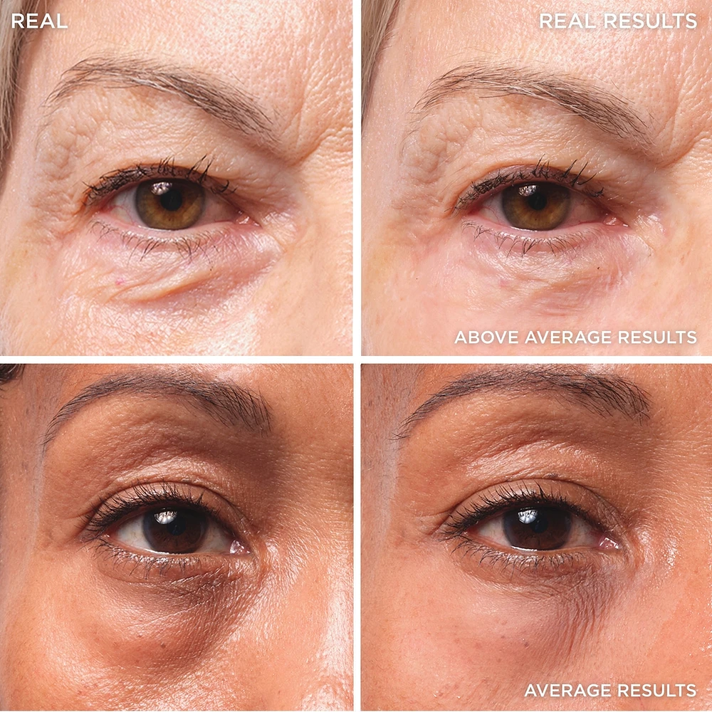 Bye Bye Under Eye Bags Treatment
