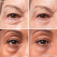 Bye Bye Under Eye Bags Treatment