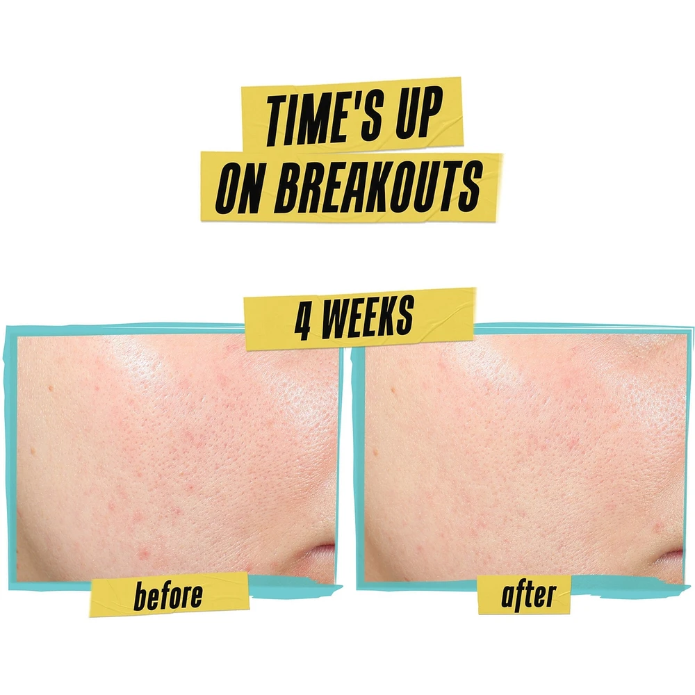 Expertly Clear Acne Treating Lotion - Clinically Proven Daily Defense Against Acne