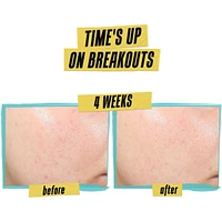 Expertly Clear Acne Treating Lotion - Clinically Proven Daily Defense Against Acne