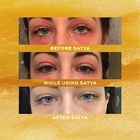 Eczema Relief Stick