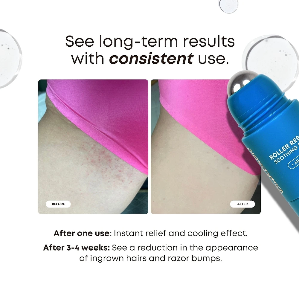 Roller Rescue Soothing Serum for Ingrown Hairs & Bumps