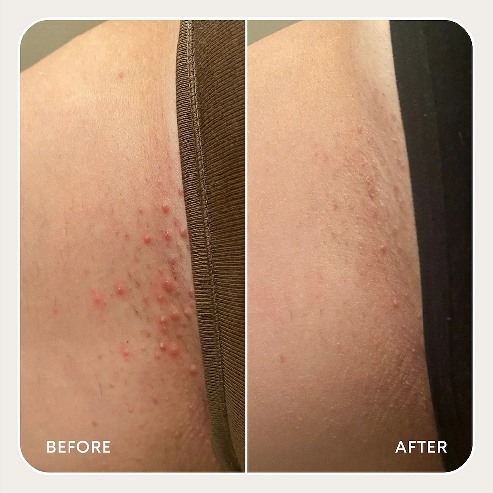 Sweet Escape Ingrown Hair Oil