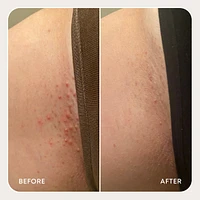 Sweet Escape Ingrown Hair Oil