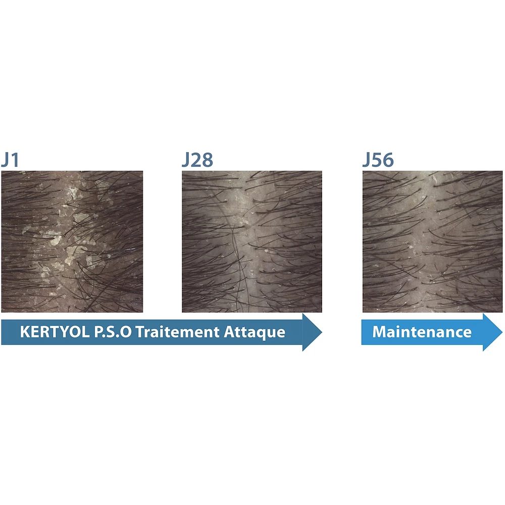 Kertyol PSO shampoo