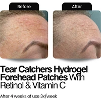 Tear Catchers Hydrogel Wrinkle & Stress-Relief Forehead & Eye Therapy Kit with Retinol & Vitamin C (x2 sets)