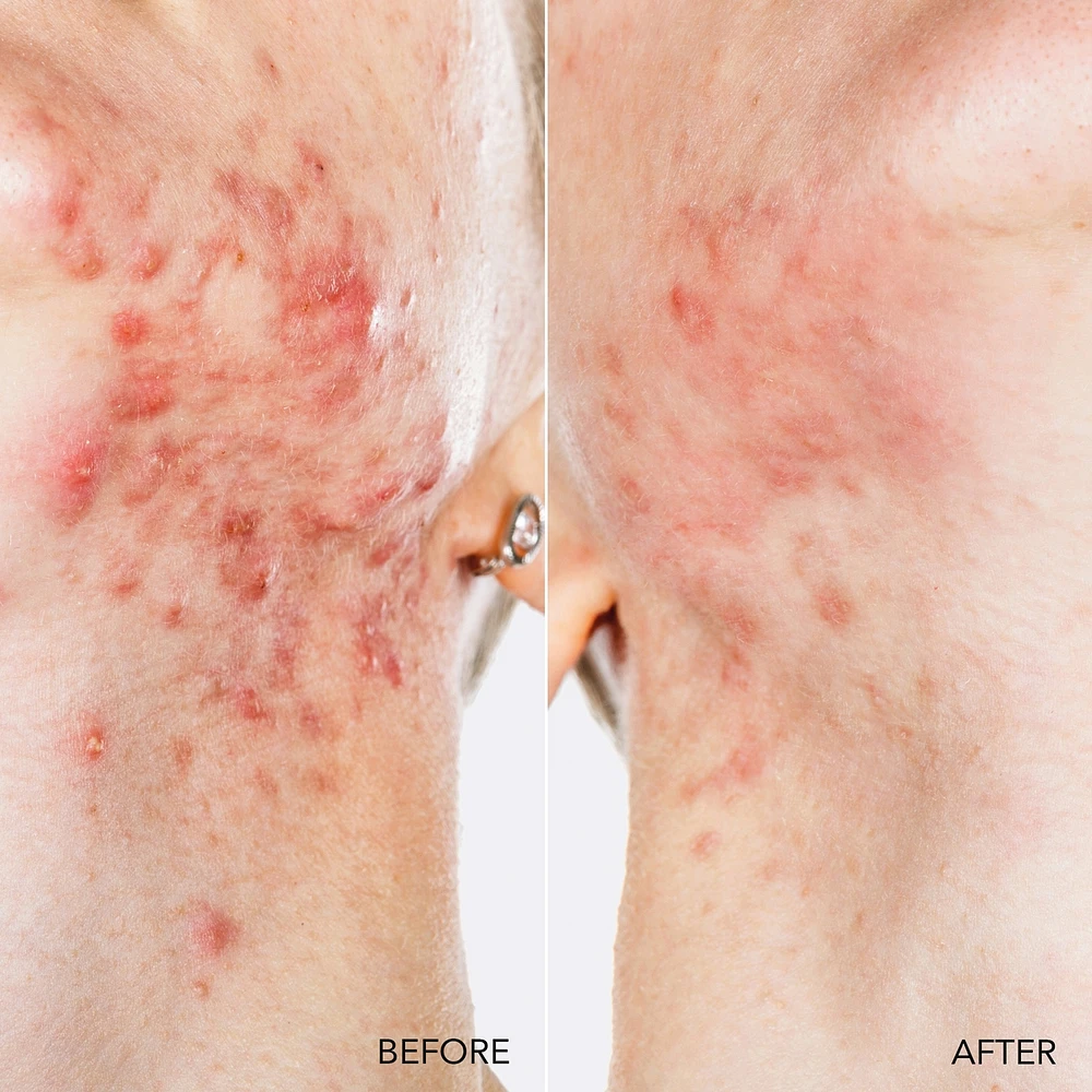 ESPADA™ 2 plus Pistachio Targeted Blue LED Light Acne Treatment