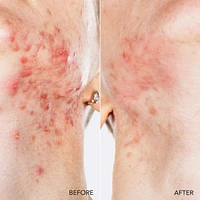 ESPADA™ 2 plus Pistachio Targeted Blue LED Light Acne Treatment