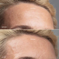 KIWI™ derma Diamond Microdermabrasion & Pore Vacuum