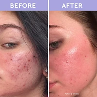 Spot A Spot Exfoliating Solution