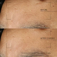 Advanced Night Repair Overnight Treatment