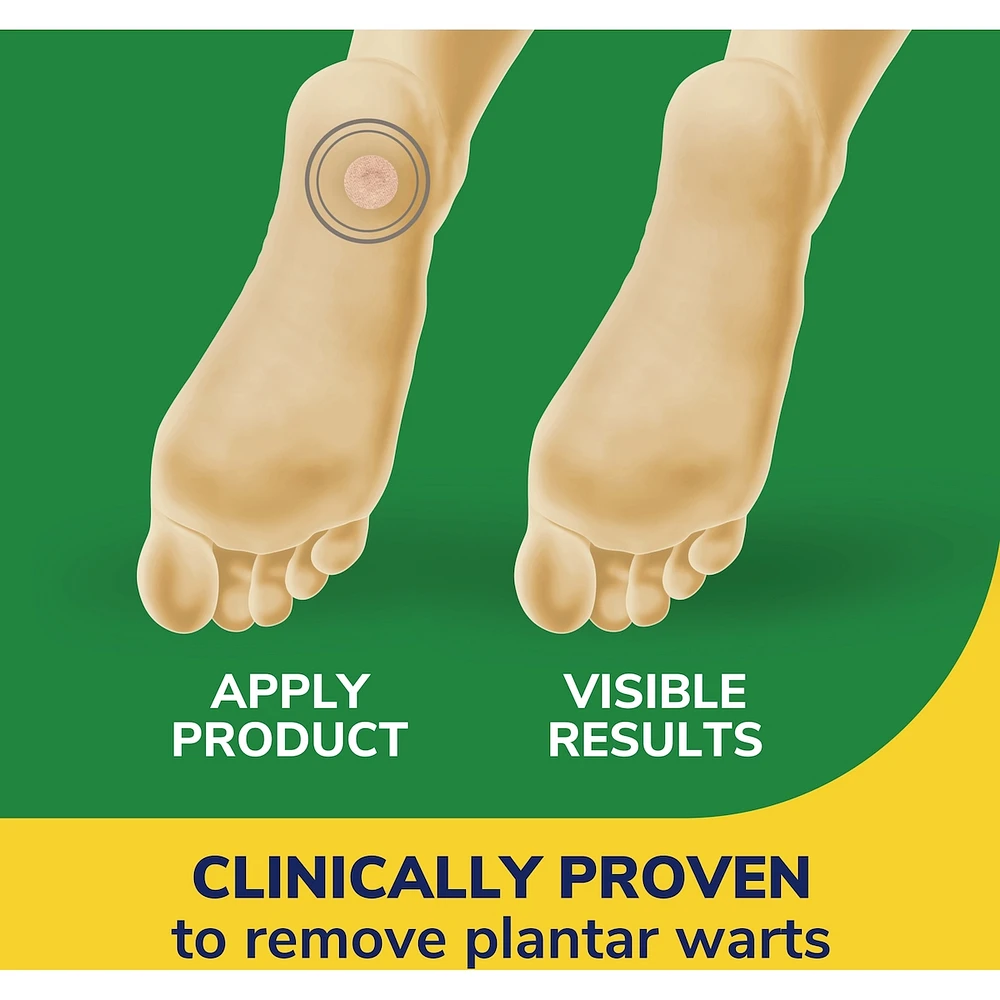 DS Clear Away Plantar Wart Remover