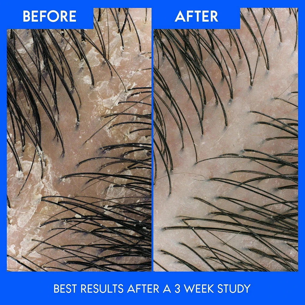 Head & Shoulders Dry Scalp 2-in-1 Anti-Dandruff Shampoo + Conditioner, 370ML