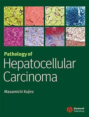 Pathology of Hepatocellular Carcinoma