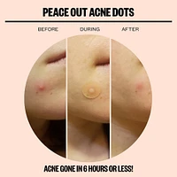 Salicylic Acid Acne Healing Dots - 20 ct