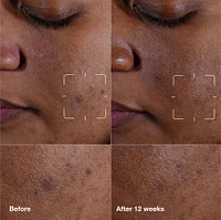 Even Better Clinical Dark Spot Clearing Serum with Vitamin C