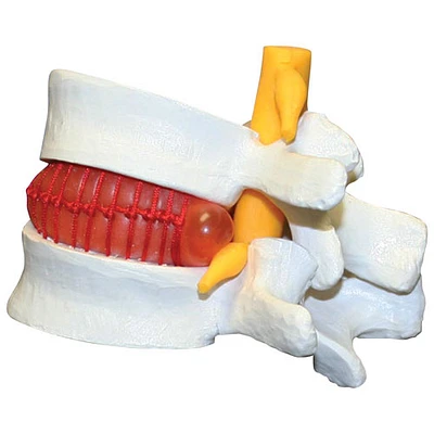 Walter Products Plastic Prolapsed Intervertebral Disc