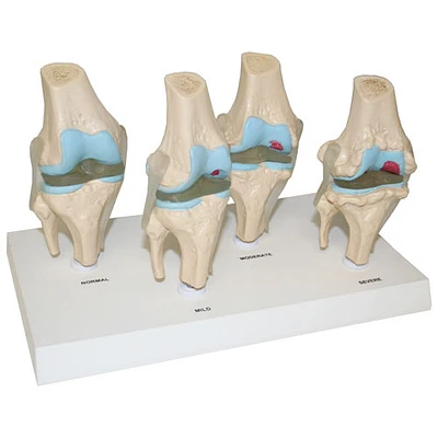 Walter Products 4 Stages of Disease Knee Joint Model