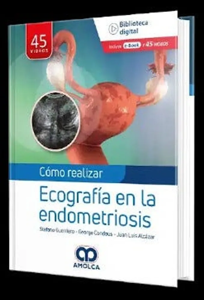 Cómo realizar Ecografía en la endometriosis + e-book y videos gratuitos