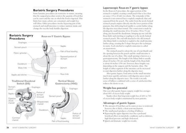 The Complete Bariatric Surgery Guide and Diet Program: Includes 150 Recipes for Lifelong Weight-Loss Success