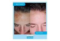 Admire My Skin Dark Spot Corrector Remover for Face Ultra Potent Brightening Serum