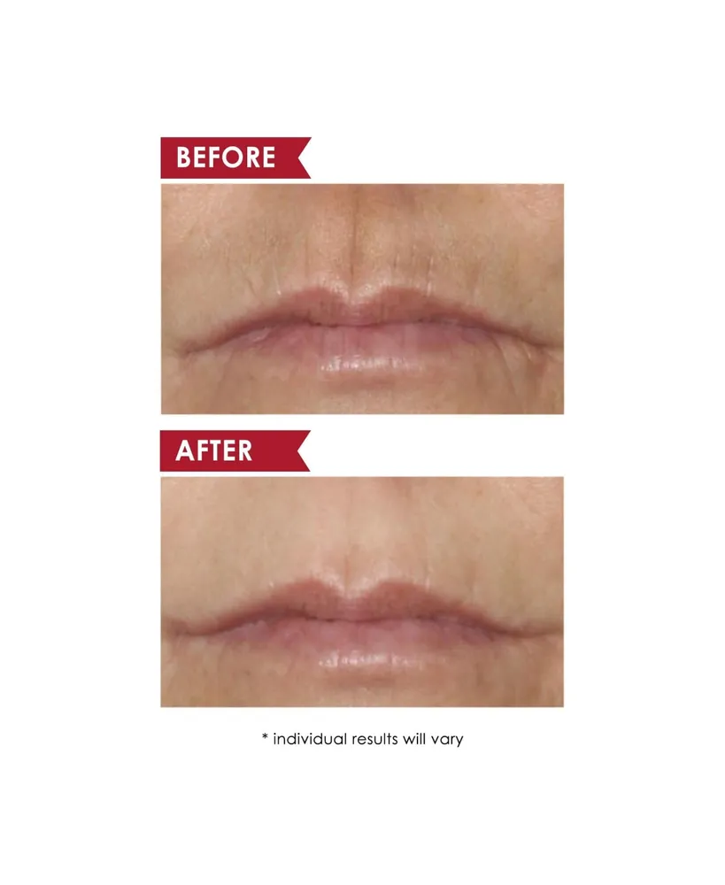 Dermelect Smooth Upper Lip Professional Perioral Anti-Aging Treatment