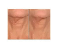 SiO Beauty NeckLift